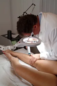 Laserové ošetření mikrovarixů- metliček